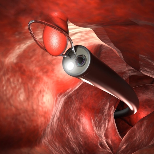 Endoscopic Therapeutic