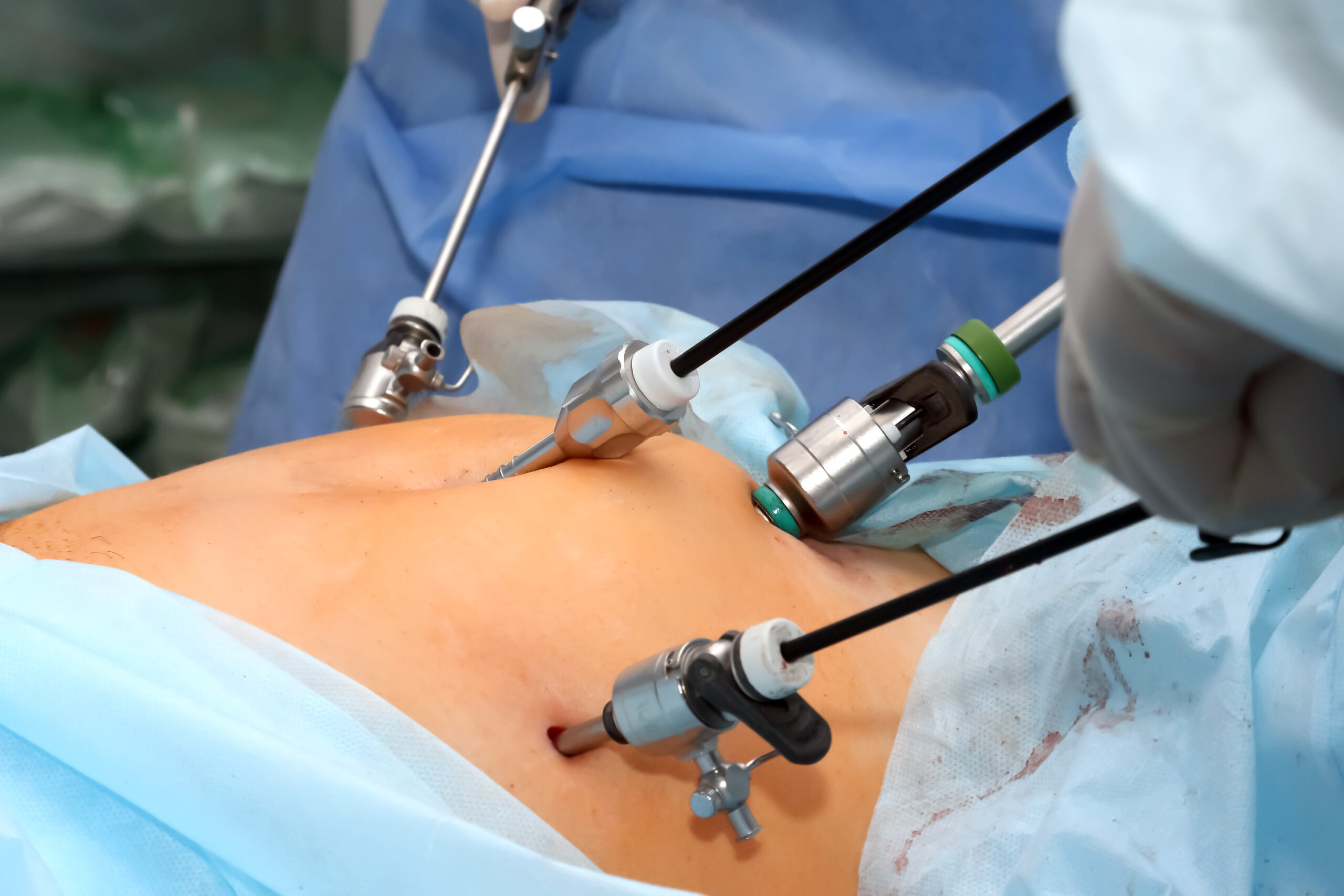 Laparoscopic Hysterectomy Treatment